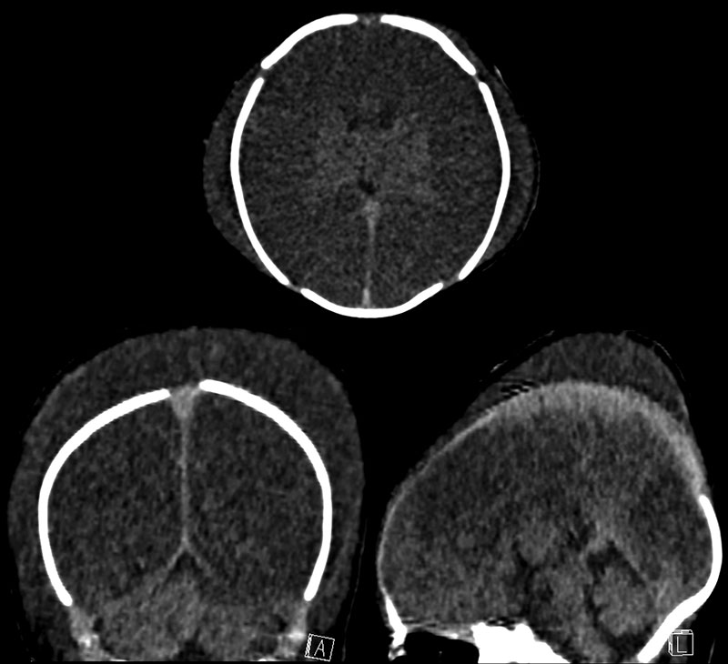 Diagnosing Caput Succedaneum