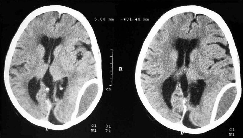 cephalohematoma calcifications