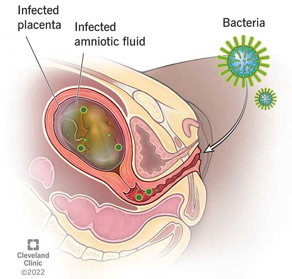Chorioamnionitis