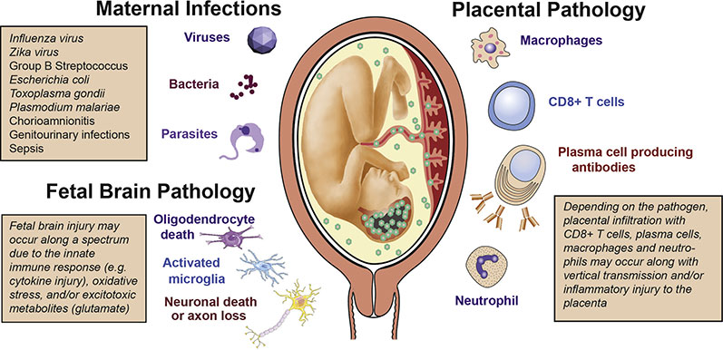 chorioamnionitis