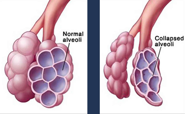 respiratory distress syndrome