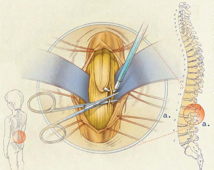 SDR Incision