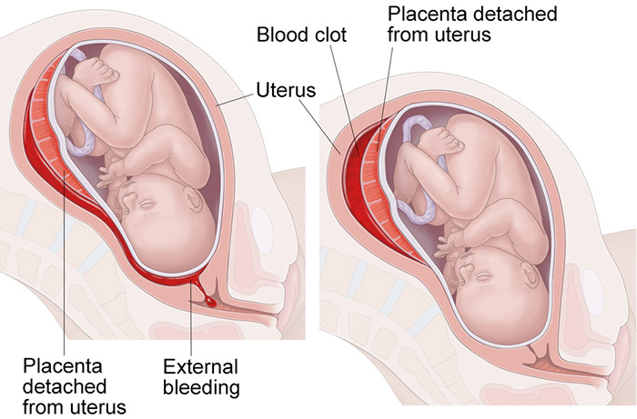 placental abruption