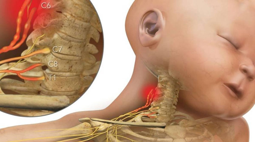 brachial plexus