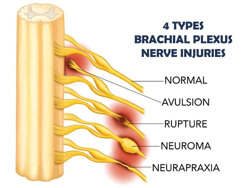 Types of Brachial Plexus