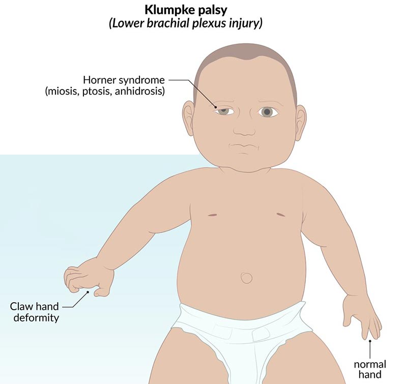 Klumpke's Paralysis