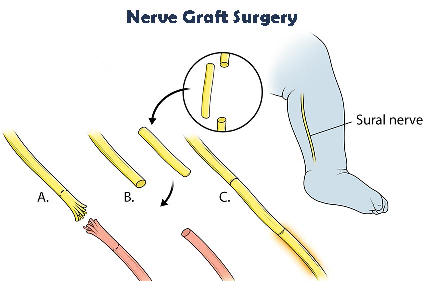 brachial plexus nerve grafting