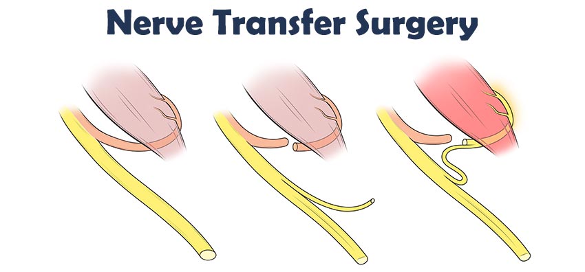 brachial plexus nerve transfer