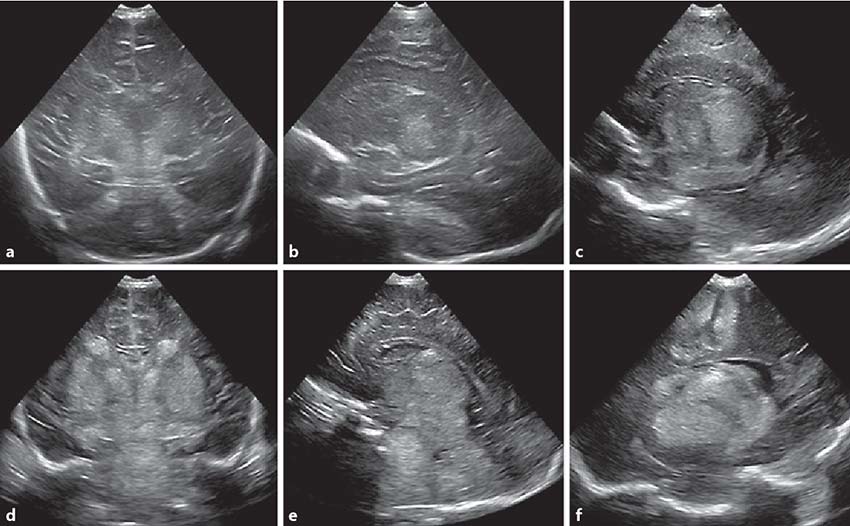 cranial ultrasound HIE