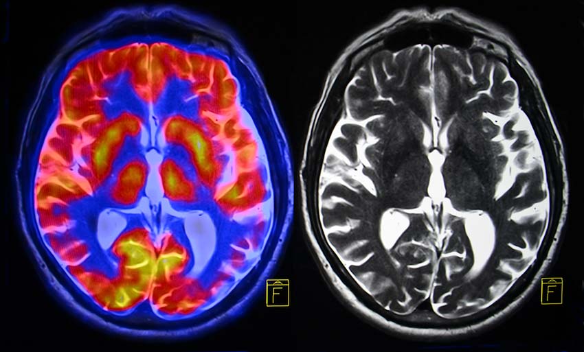 Functional MRI