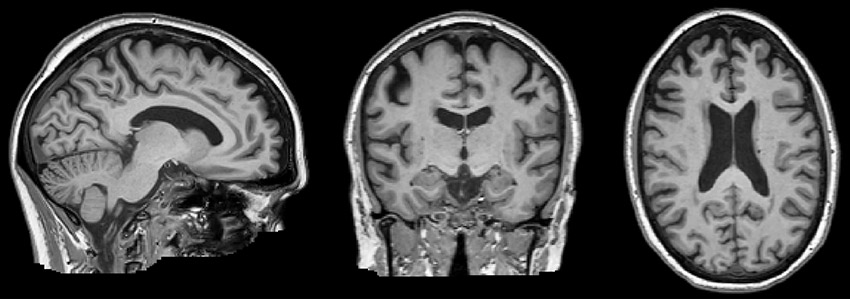 Structural MRI