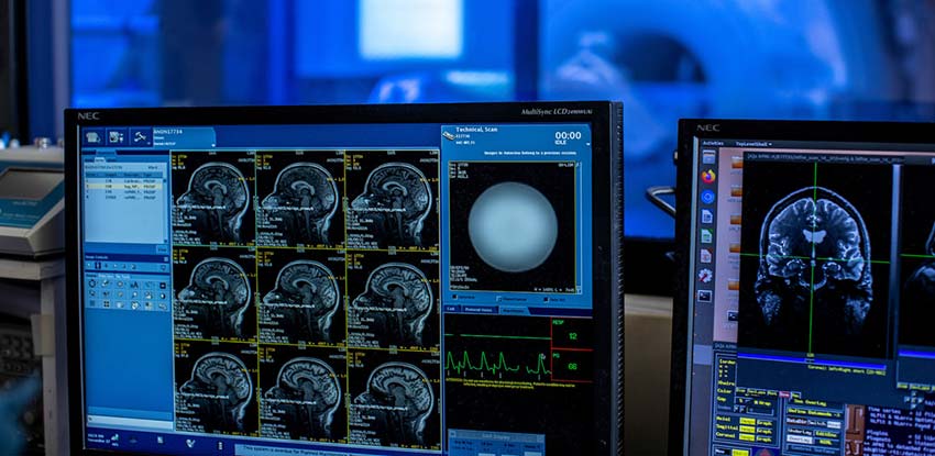 skull fracture imaging