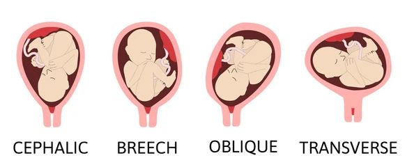 fetal presentation