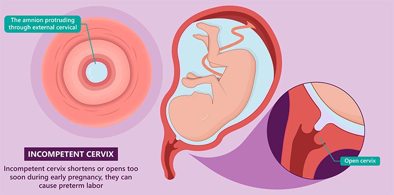 incompetent cervix