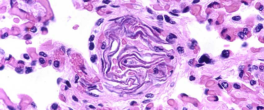 amniotic fluid embolism