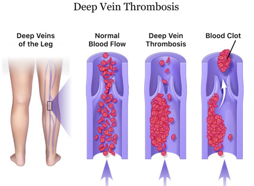 deep venous thromboembolism (DVT)