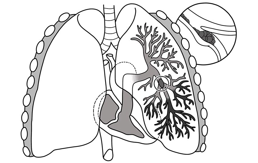 Deep venous Thromboembolism 