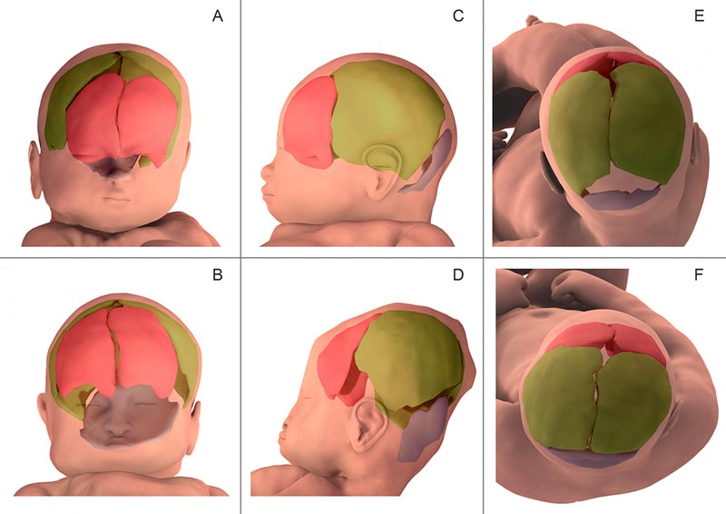 3-D MRI neonatal cerebral compression