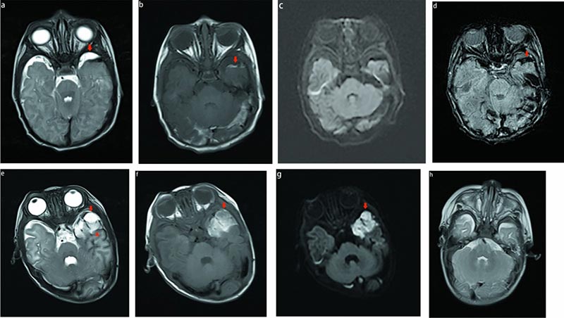 neonatal cerebral compression MRI