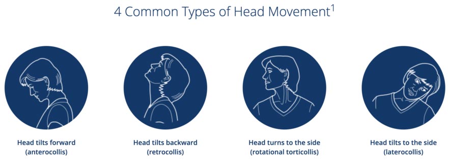 Types of Cervical Dystonia