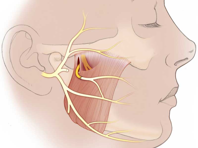 facial nerve transfer