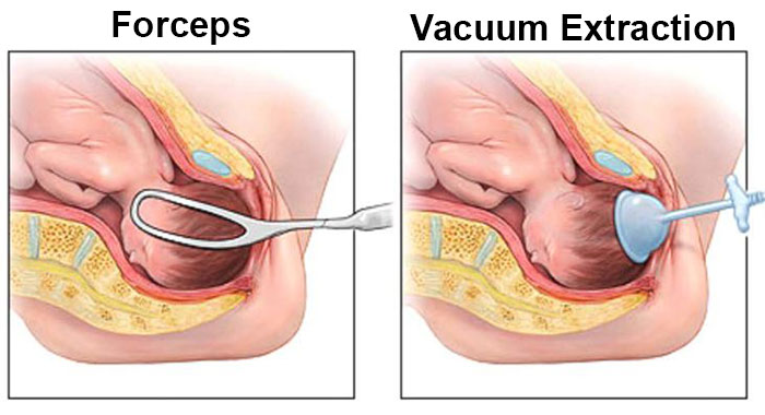 assisted delivery methods