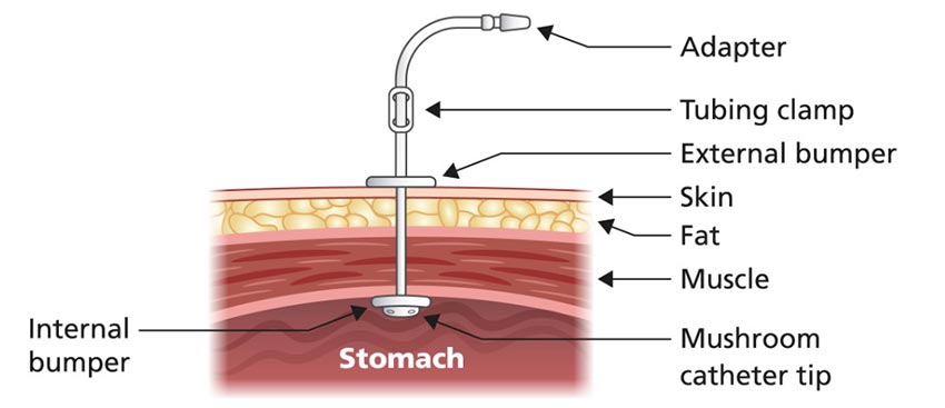 percutaneous endoscopic gastrostomy procedure