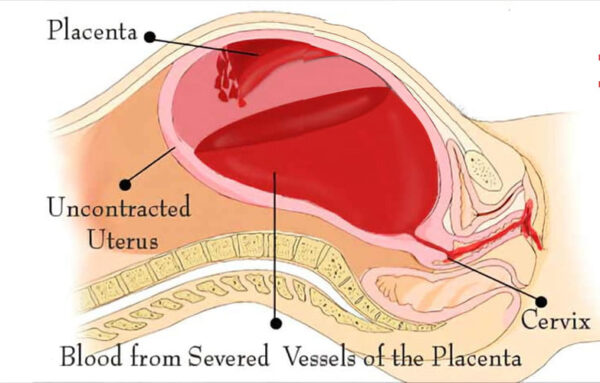 Postpartum Hemorrhage