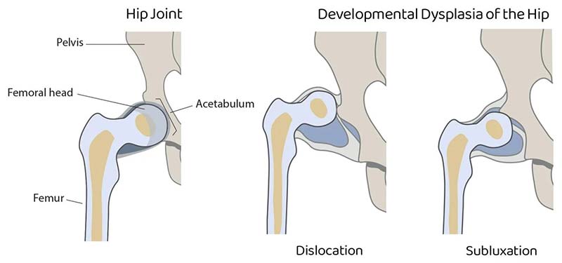 Hip Subluxation