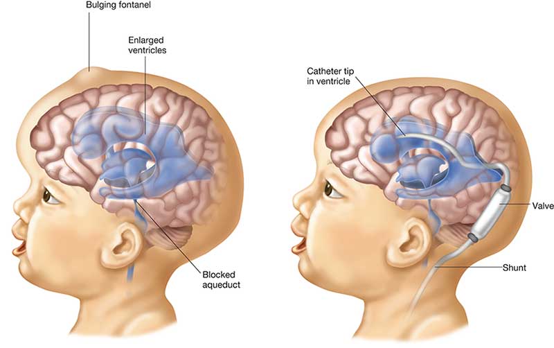 Hydrocephalus Shunt Placement