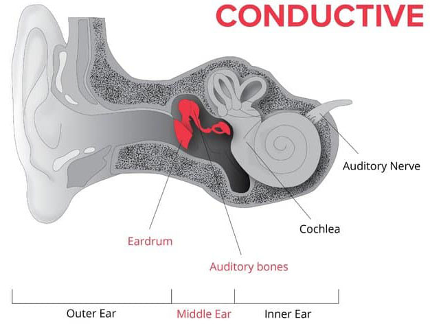 Conductive Hearing Loss