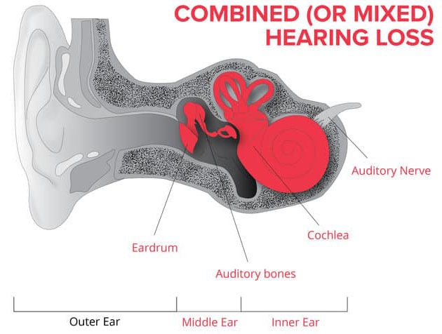 Mixed Hearing Loss