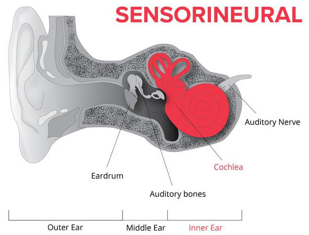 Sensorineural Hearing Loss