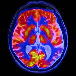 HIE Brain Imaging