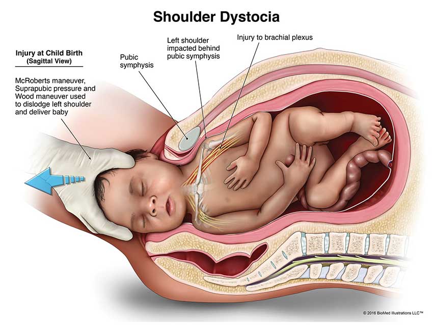 shoulder dystocia