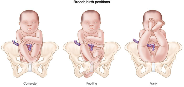 breech fetal positions