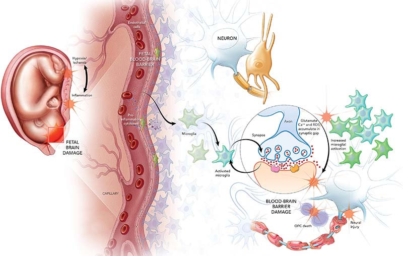 fetal brain damage