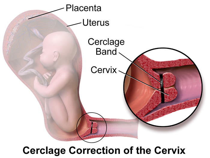 Cervical cerclage preterm birth prevention