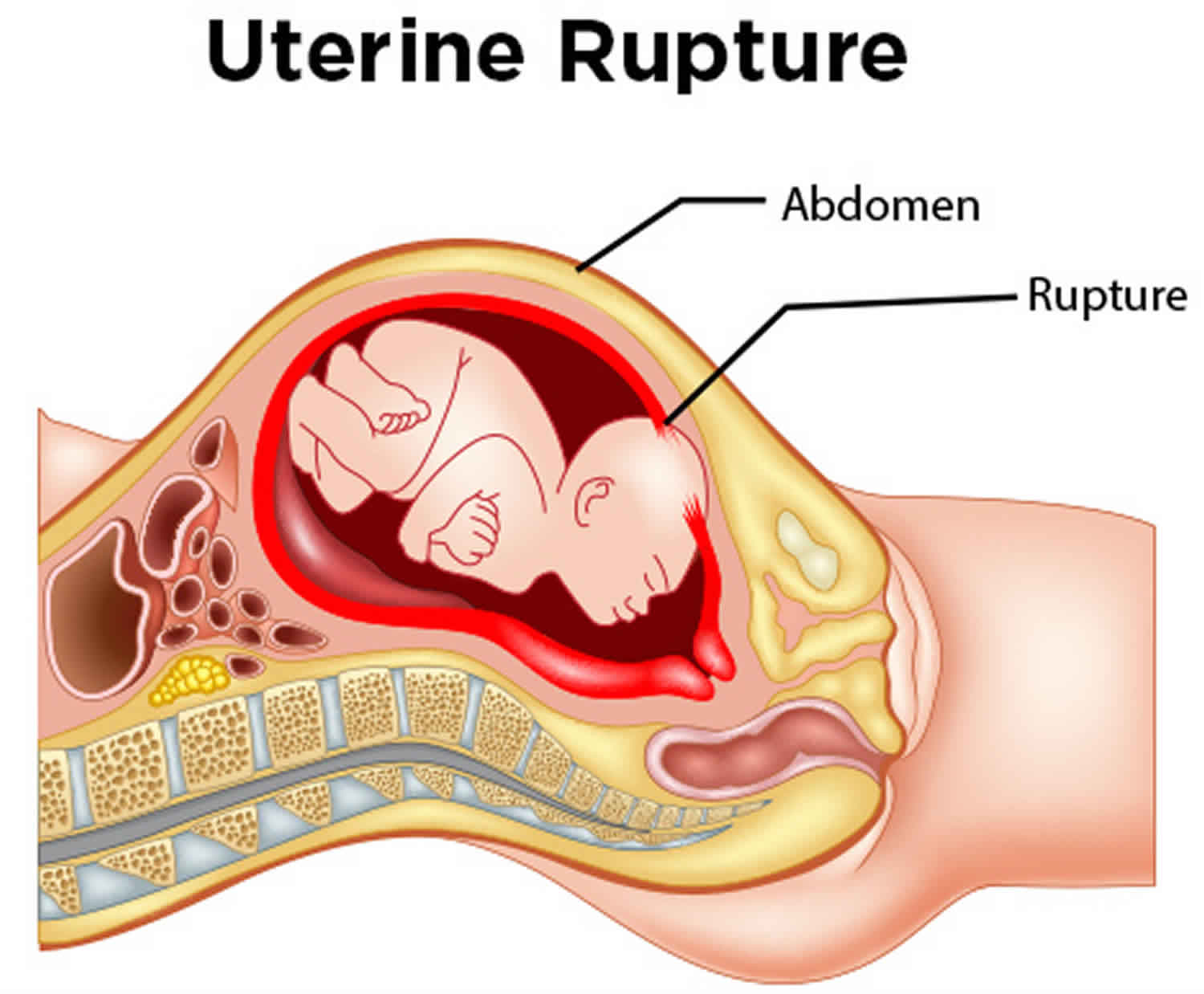 uterine rupture