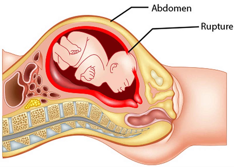 What is a Uterine Rupture