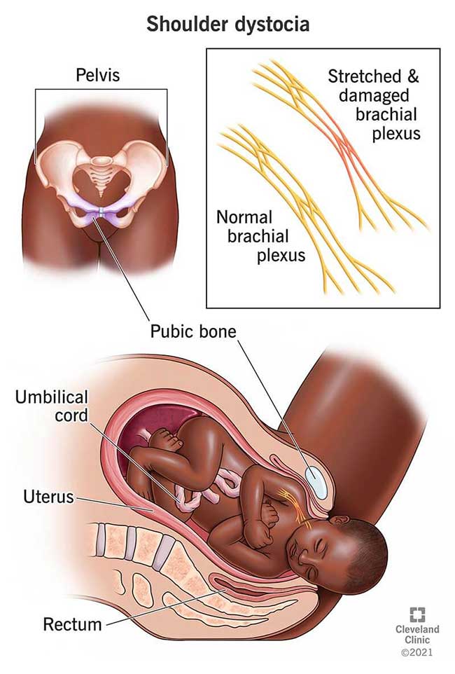 What Is Shoulder Dystocia