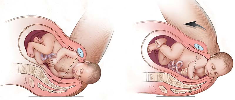 Shoulder Dystocia McRoberts Maneuver