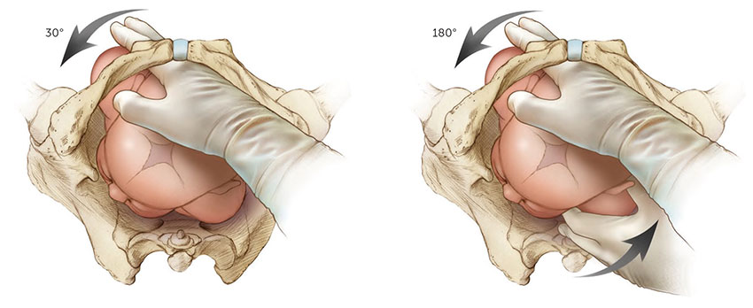 Shoulder Dystocia Woods Maneuver