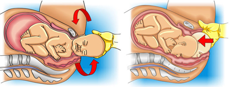 Shoulder Dystocia Zavanelli Maneuver