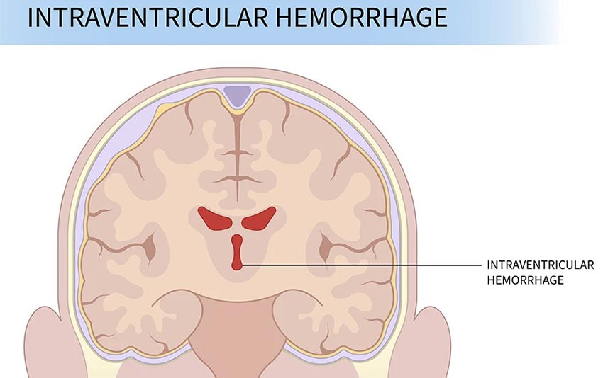 intracranial hemorrhage