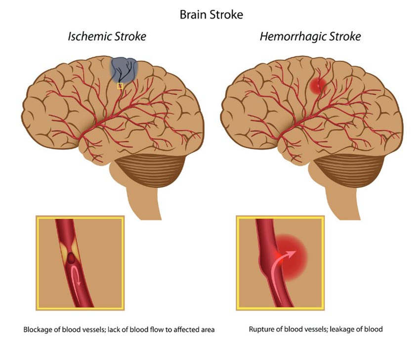 types of newborn stroke