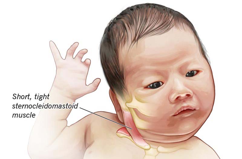 What is Torticollis