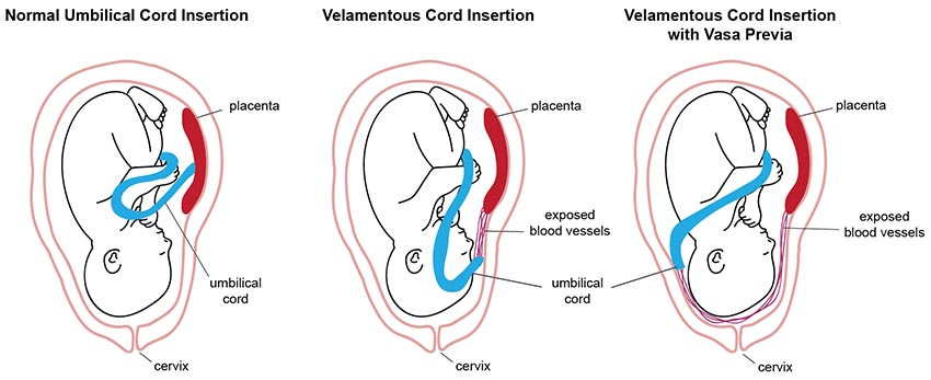 marginal cord insertion vs. velamentous cord insertion