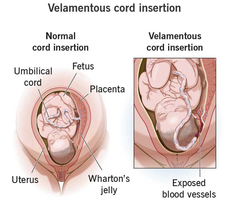 Velamentous Cord Insertion