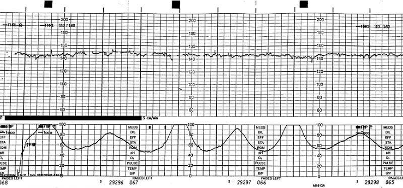 Uterine Hyperstimulation